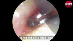 귀지 형성의 원인과 배출기전