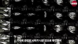 뇌전증 환자의 뇌파 연구